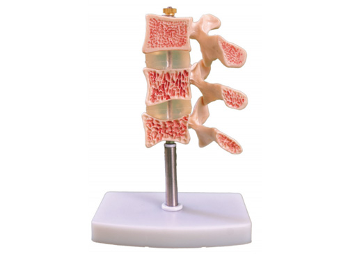 脊椎典型病变模型
